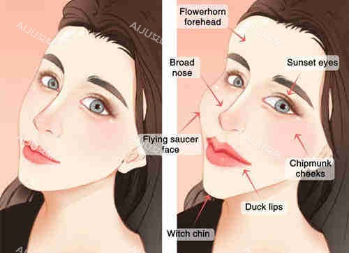 女性面部填充 女性面部填充