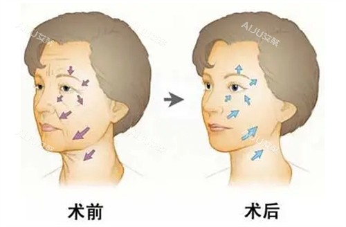 面部年轻化管理前后对比