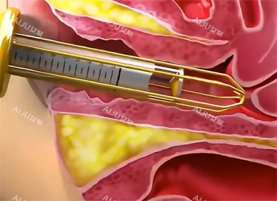 紧缩针过程示意图 紧缩针过程示意图