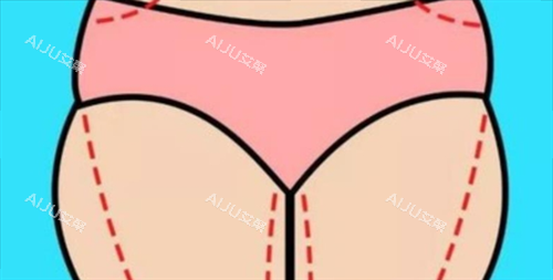 大腿吸脂术前画线展示图
