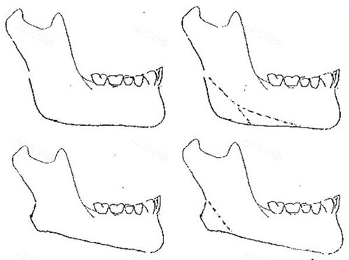 下颌角整形多次截骨示意图 下颌角整形多次截骨示意图
