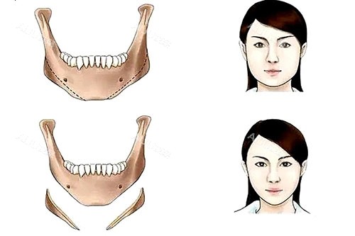 下颌角整形卡通对比图 下颌角整形卡通对比图