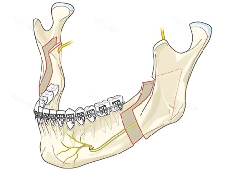 下颌角手术动画 下颌角手术动画