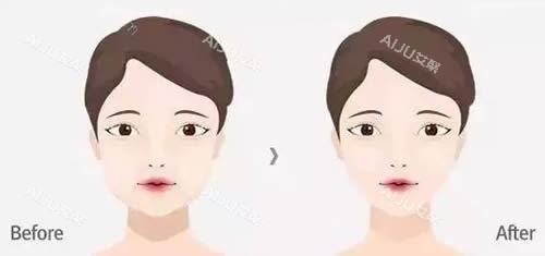 面部轮廓整形前后对比图 面部轮廓整形前后对比图