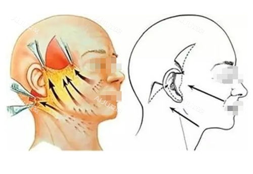 拉皮手术前后提拉对比图 拉皮手术前后提拉对比图