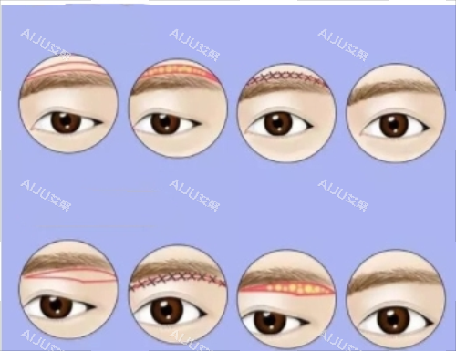 提眉手术完整流程图 提眉手术完整流程图