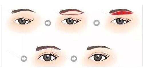 提眉手术步骤示意图 提眉手术步骤示意图