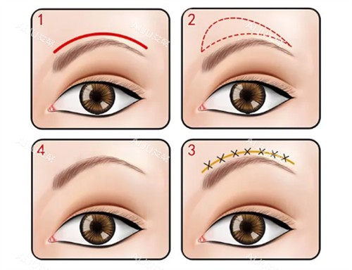 提眉不同切口 提眉不同切口