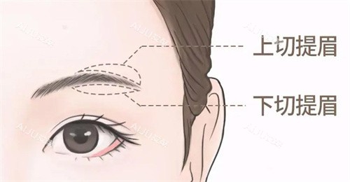 提眉手术不同切口 提眉手术不同切口