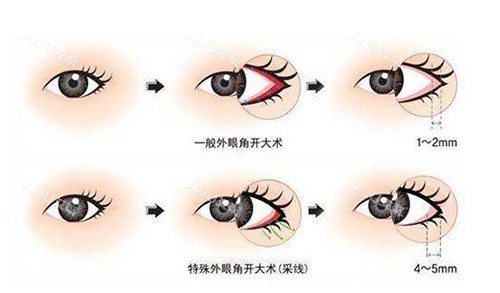 开外眼角手术过程