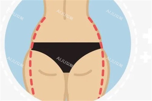 臀部吸脂 臀部吸脂