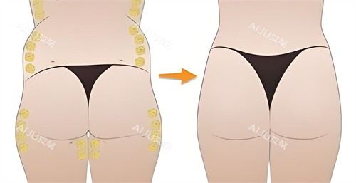 臀部吸脂手术脂肪部位演示动画图 臀部吸脂手术脂肪部位演示动画图