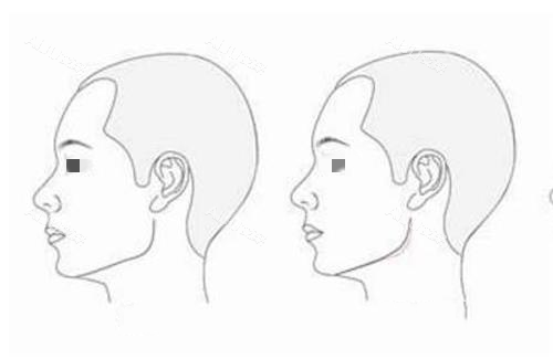 磨骨前后对比图 磨骨前后对比图