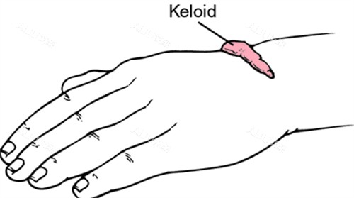 疤痕疙瘩3 疤痕疙瘩3