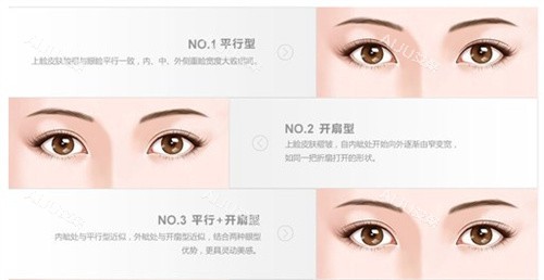 双眼皮的类型 双眼皮的类型