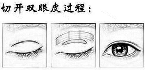 切开双眼皮 切开双眼皮