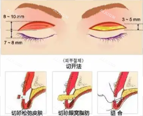 切开双眼皮手术 切开双眼皮手术