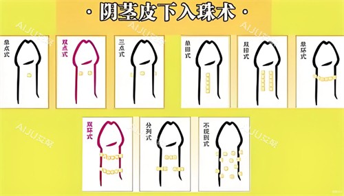 阴茎皮下入珠术