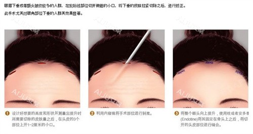 内窥镜提升额头适合人群