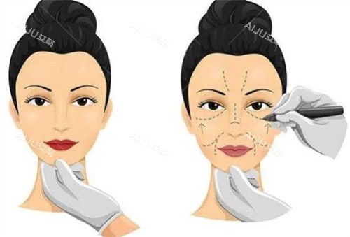 小拉皮手术过程