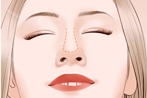 隆鼻鼻梁位置示意图 隆鼻鼻梁位置示意图