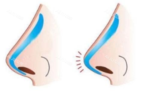 假体隆鼻示意图 假体隆鼻示意图