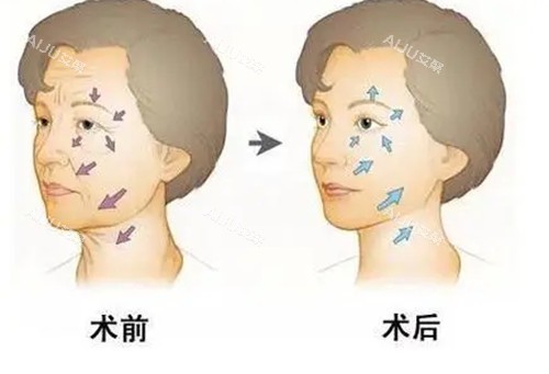 面部抗衰前后对比卡通示意图 面部抗衰前后对比卡通示意图