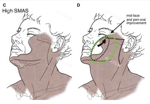 面部提升图示一览