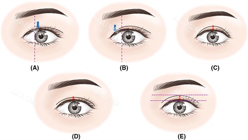 调整双眼皮宽度 调整双眼皮宽度