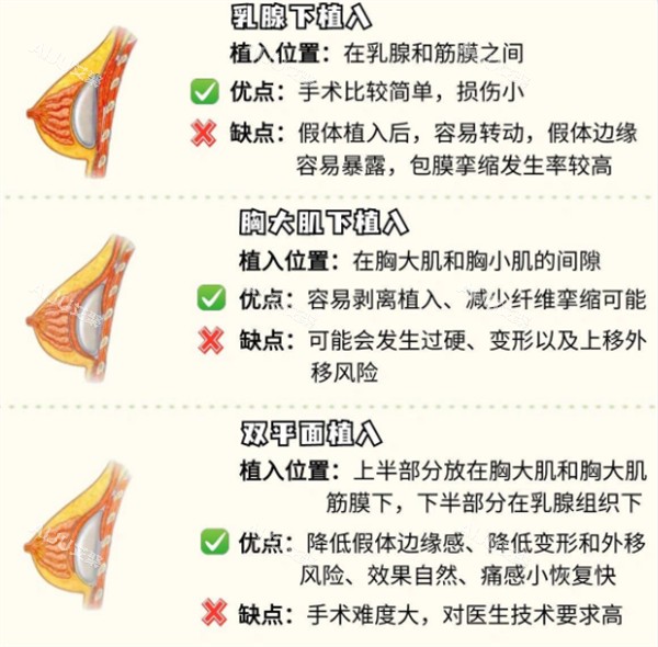 假体隆胸的不同植入位置图解