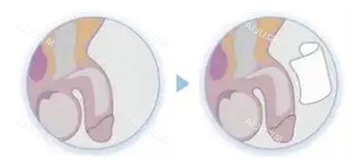 阴茎生物补片手术过程介绍
