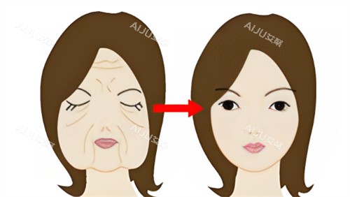 面部抗衰前后对比 面部抗衰前后对比