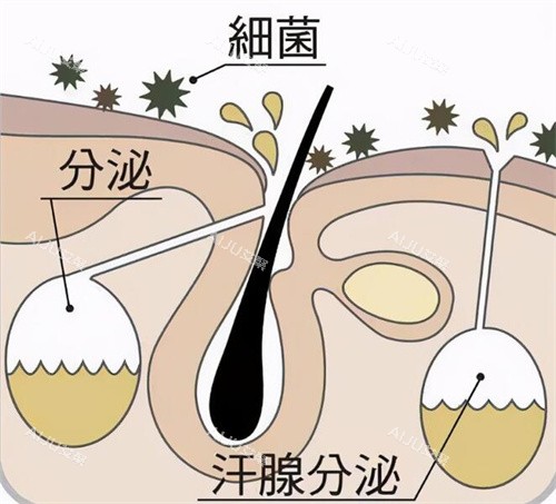 腋臭是怎么形成的 腋臭是怎么形成的