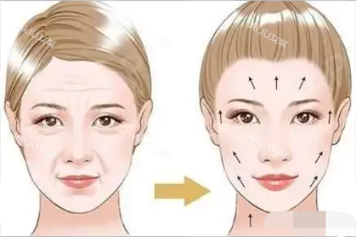 拉皮对比图 拉皮对比图