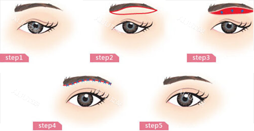 眉弓骨整形手术 眉弓骨整形手术