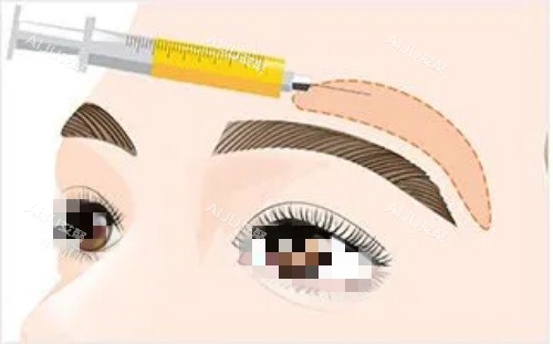 膨体眉弓操作示意图 膨体眉弓操作示意图