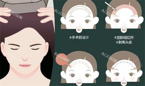 额头缩小手术过程