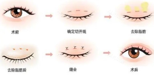 双眼皮手术过程图 双眼皮手术过程图