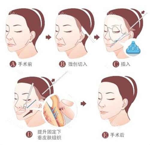 拉皮手术过程图 拉皮手术过程图