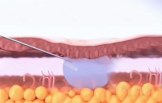 紧缩针填充私密位置照片 紧缩针填充私密位置照片