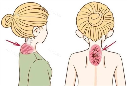 改善富贵包前后对比