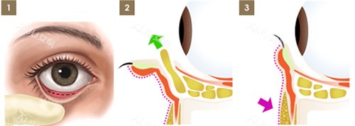 眼袋手术图解