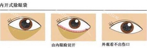 内切法祛眼袋手术过程