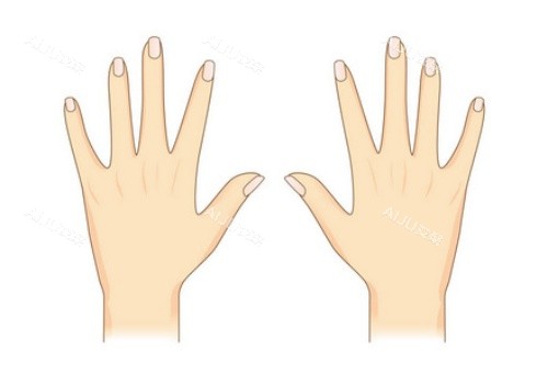 手背拉皮术后示意图