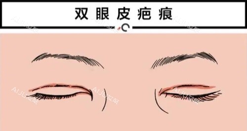 双眼皮疤痕修复动画图 双眼皮疤痕修复动画图
