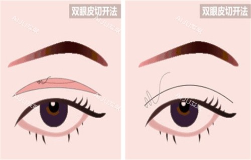 全切双眼皮手术的切口部位 全切双眼皮手术的切口部位