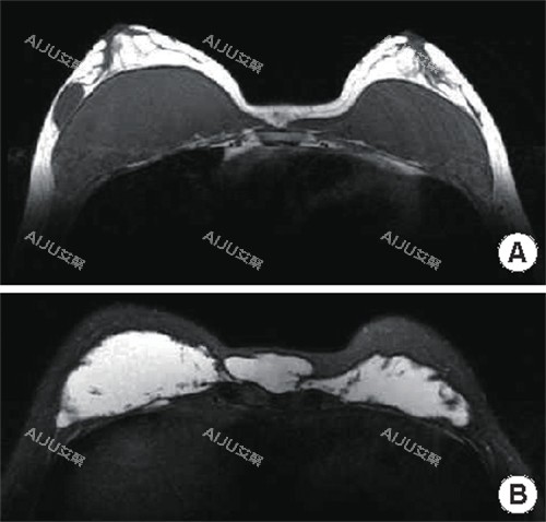 不明注射物在胸部中的样子