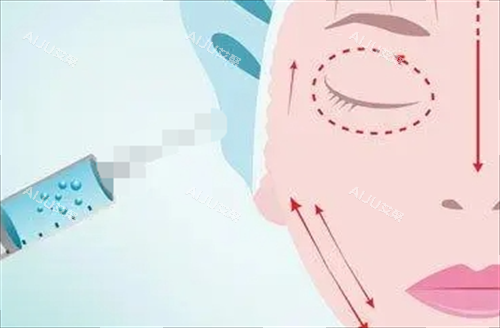 玻尿酸面部填充示意图