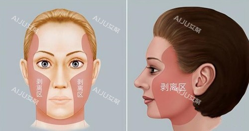 拉皮手术剥离区 拉皮手术剥离区