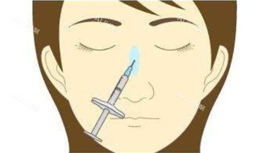 注射隆鼻正面 注射隆鼻正面